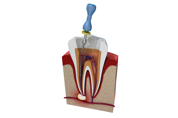 根管治療（歯内療法） | 半蔵門の歯医者「パール歯科医院 半蔵門 
